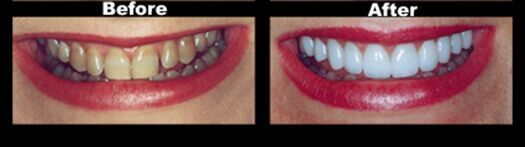 A before and after picture of a woman 's teeth