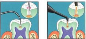 A picture of a tooth being drilled and a picture of a tooth being filled with a filling.