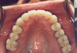 A close up of a person 's teeth with braces on them.