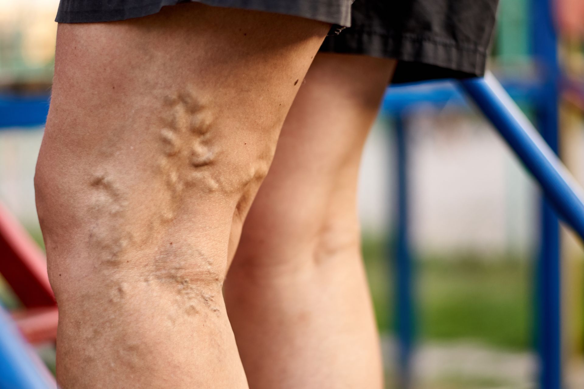 A close up of a person 's legs with varicose veins.