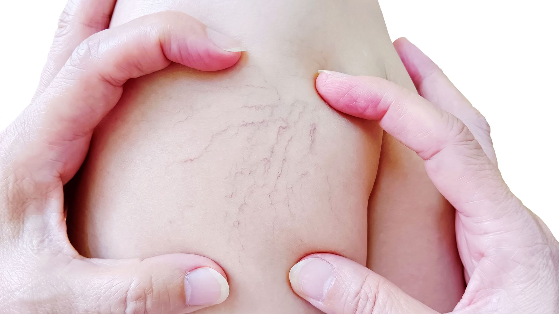 Hands examining skin with visible spider veins.