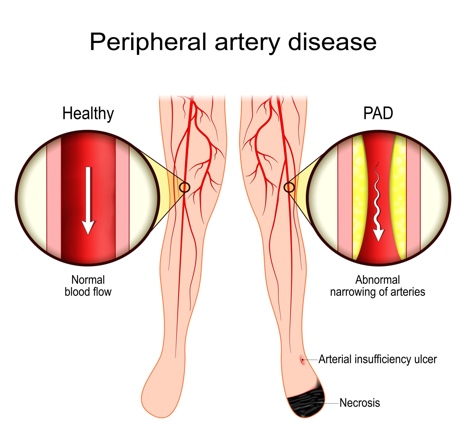 Diagram comparing a healthy artery to one narrowed by peripheral artery disease, showing reduced blood flow and necrosis.