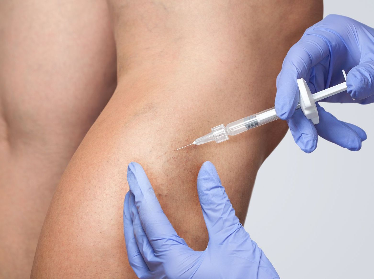 woman holding leg with varicose vein on it