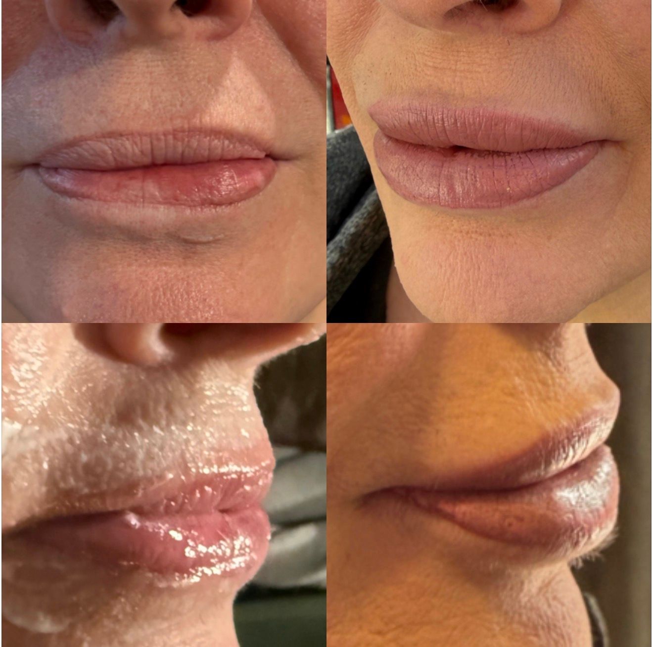 beautiful lip filler 