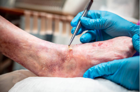 Diabetic Foot Ulcer Treatment