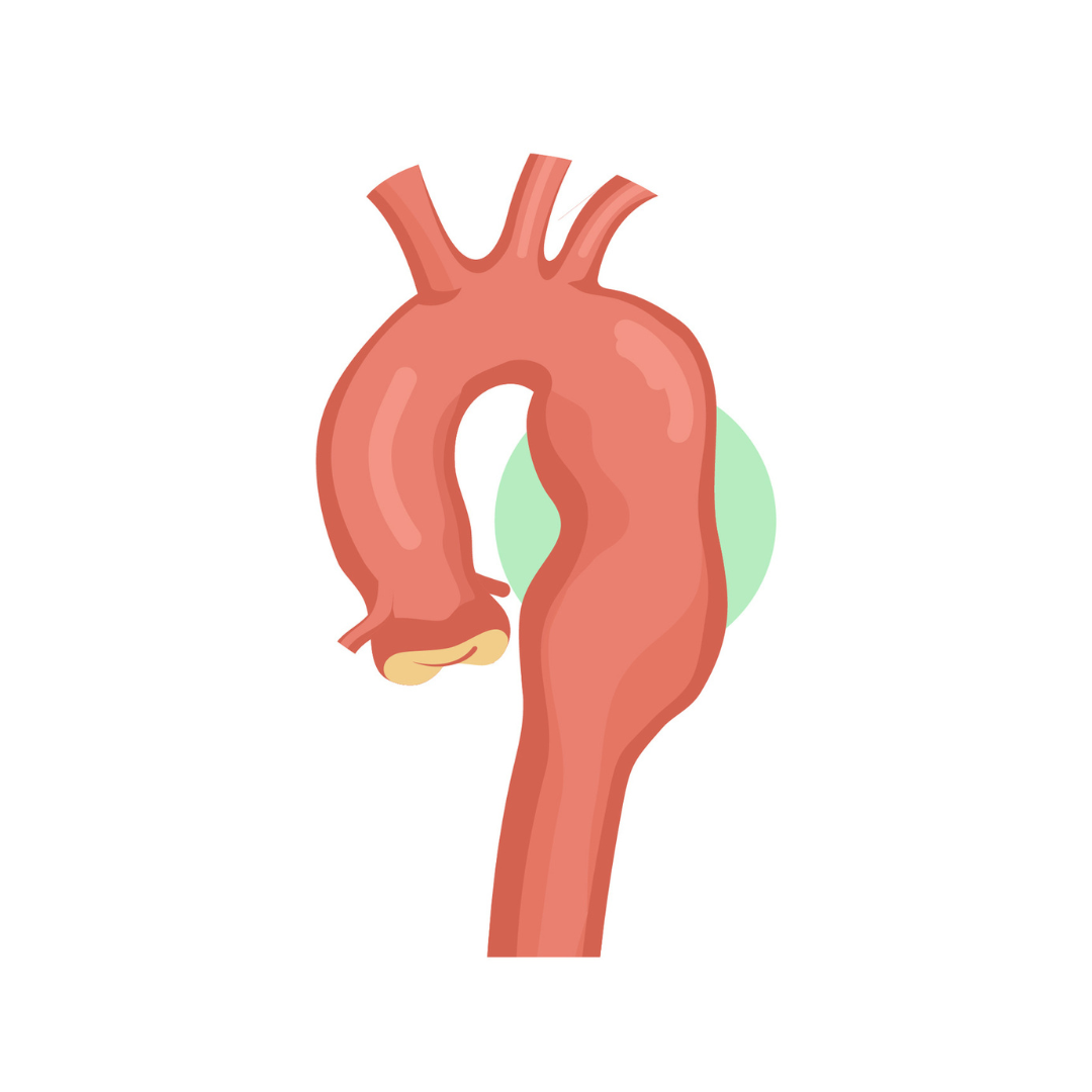 Desenho da aorta com aneurisma, mostrado em vermelho com um círculo verde marcando a área afetada.