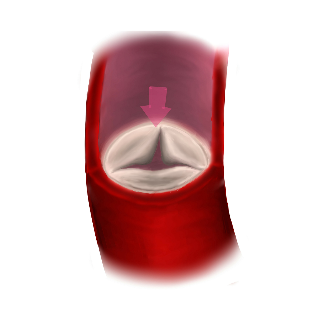 Ilustração de uma válvula cardíaca, representada por abas brancas, dentro de um vaso vermelho. Uma seta rosa indica a direção do fluxo.
