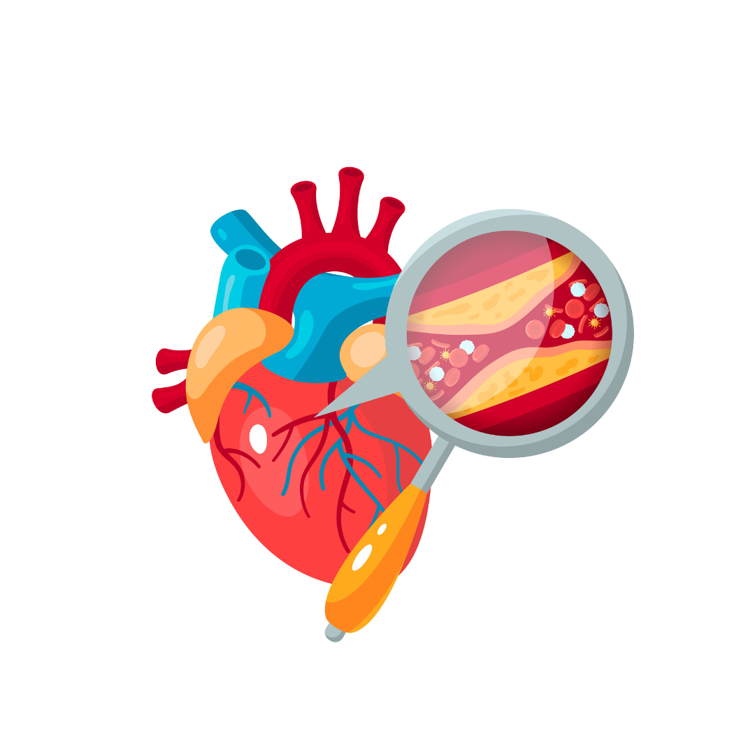 Um coração com uma lupa mostrando um close de artérias bloqueadas, indicando doença cardiovascular.