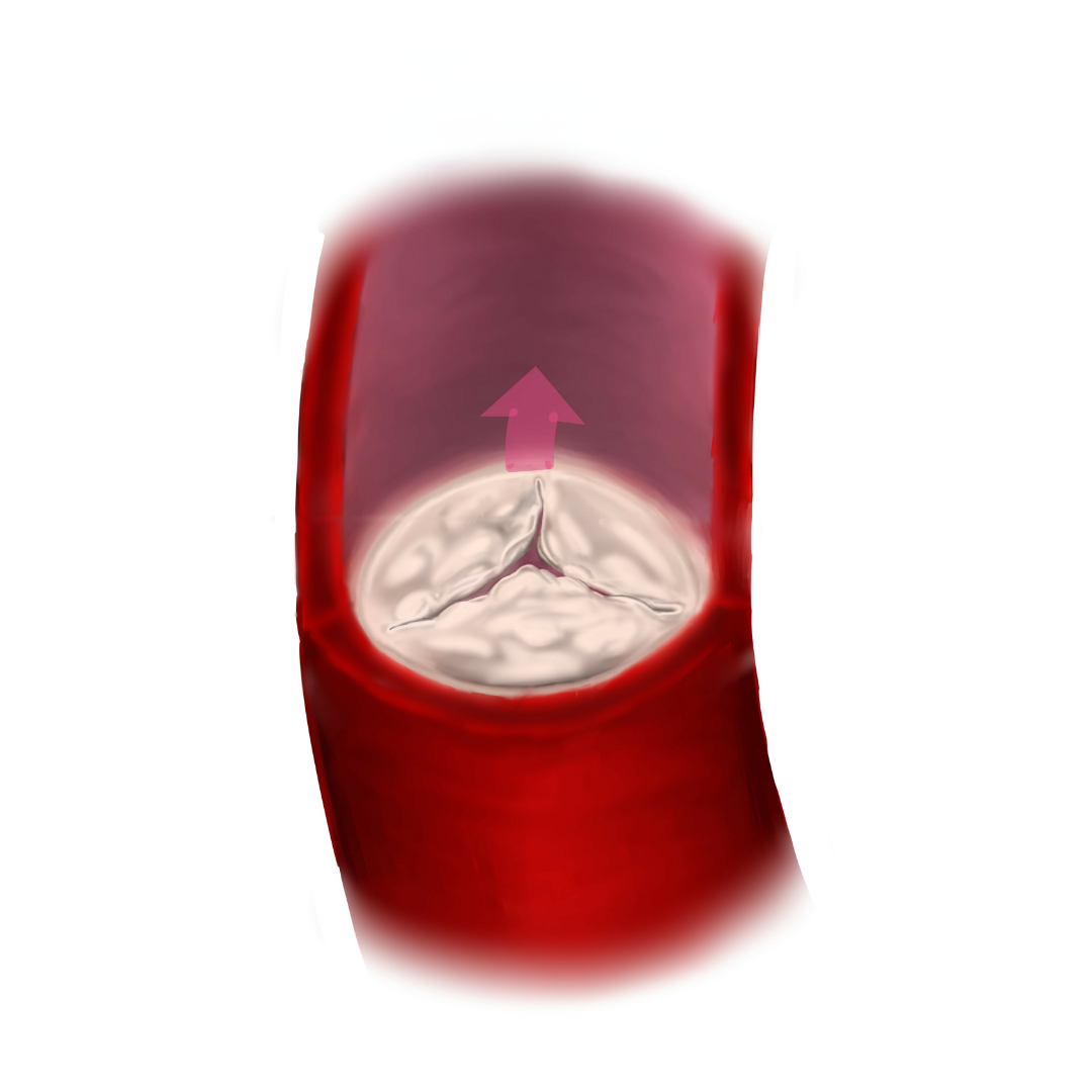 Corte transversal de um vaso sanguíneo com uma válvula cardíaca se abrindo. A seta indica o fluxo sanguíneo ascendente através da válvula.