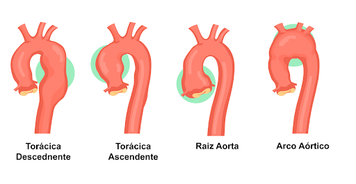 Diagrama da aorta, mostrando seções como a aorta torácica descendente e o arco aórtico. Cada seção é um vaso vermelho e curvo.