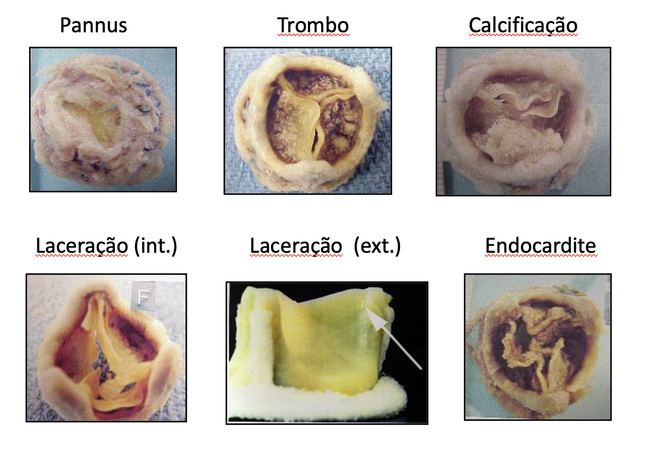 Six close-up views of damaged heart valves, labeled