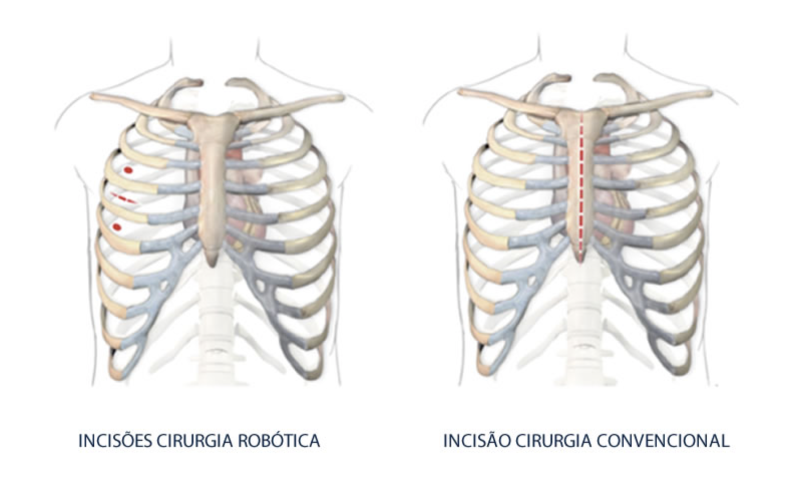 Comparação de incisões no peito: a cirurgia robótica (esquerda) mostra pequenas incisões; a cirurgia convencional (direita) tem uma única e longa incisão no esterno.