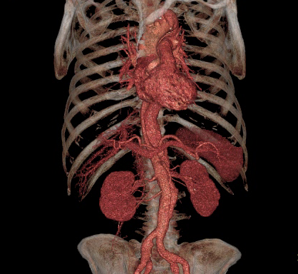Representação médica 3D de um torso humano, mostrando o esqueleto e o sistema circulatório de cor vermelha, incluindo o coração, aorta, rins e artérias relacionadas.