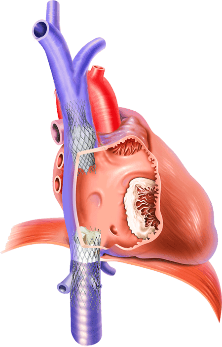 Ilustração de um coração com colocação de stent em uma veia, mostrando procedimento médico, com vasos vermelhos e azuis.