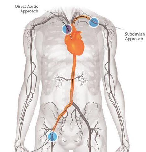 Diagrama mostrando o sistema circulatório humano, com o coração destacado em laranja e a aorta percorrendo o corpo. Círculos azuis indicam pontos de acesso.