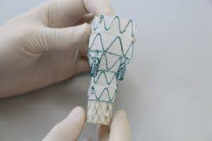 Mãos enluvadas segurando um dispositivo médico: uma válvula cilíndrica semelhante a um stent com uma estrutura semelhante a uma malha e costura azul.