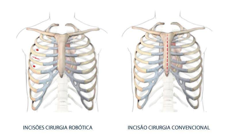 Comparação de incisões torácicas para cirurgia da válvula mitral. A cirurgia robótica tem pequenas incisões, enquanto a cirurgia convencional envolve uma grande esternotomia.