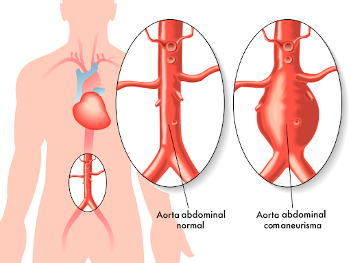Diagrama ilustrando um aneurisma da aorta abdominal. Mostra uma aorta normal e uma aorta com protuberância, em relação ao corpo humano.