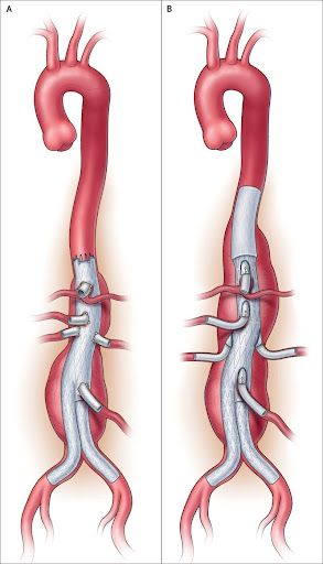 Diagrama de uma aorta com enxerto. A mostra um aneurisma reparado com enxerto, B mostra o procedimento concluído.
