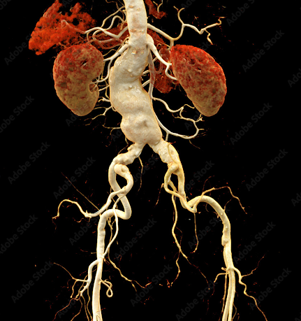 Digitalização médica 3D de um torso humano, destacando as principais artérias em branco e os rins em marrom sobre um fundo preto.