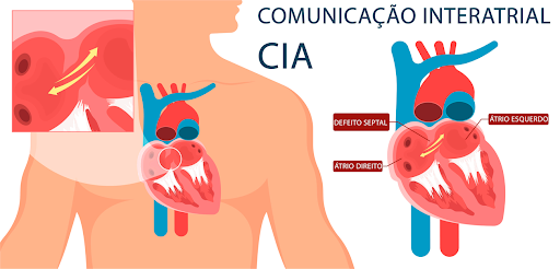 Diagrama ilustrando comunicação interatrial (CIA) no coração. Mostra o fluxo sanguíneo através de um orifício entre os átrios esquerdo e direito.