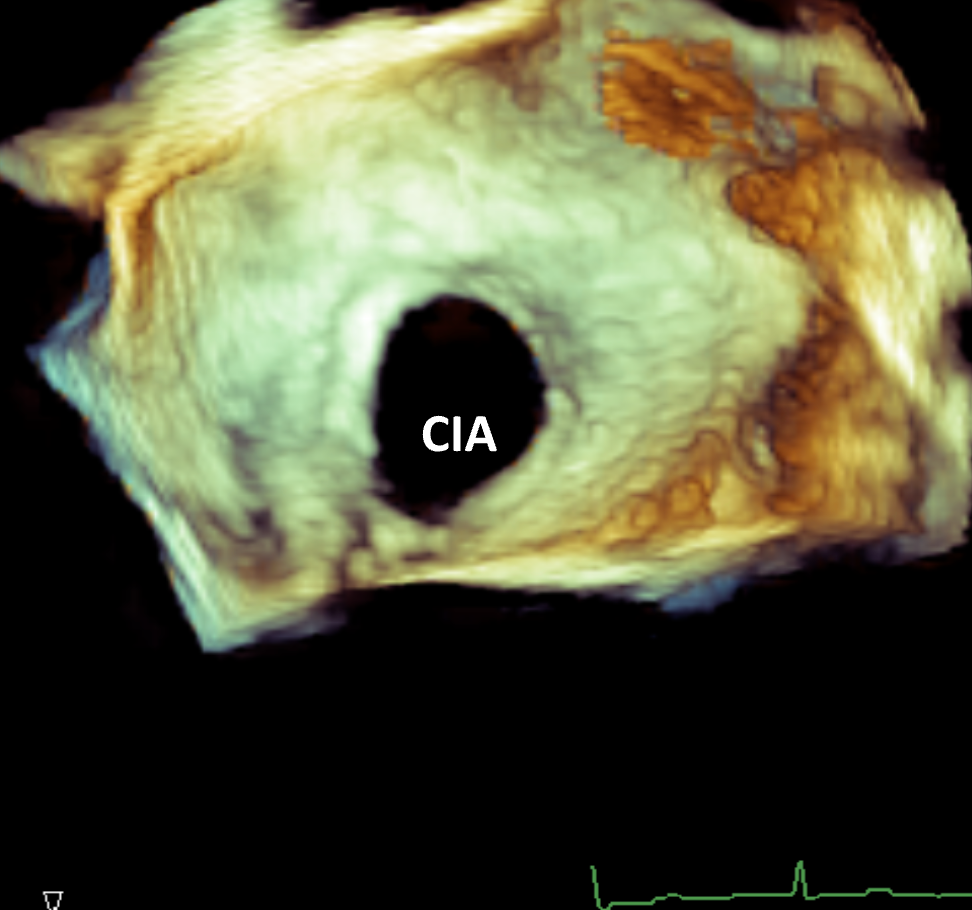 Ecocardiograma 3D do coração mostrando um defeito do septo atrial circular (CIA), com texturas de tecido codificadas por cores.