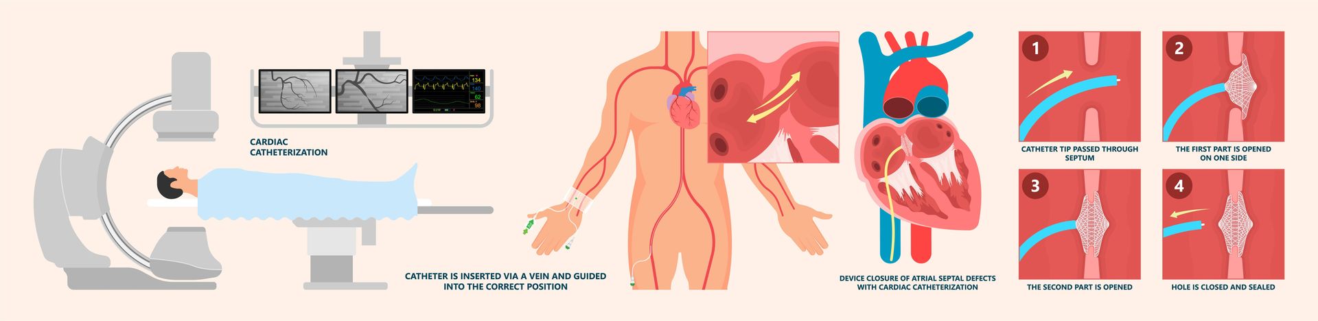 Diagrama ilustrando um procedimento de cateterismo cardíaco. Mostra um paciente submetido ao procedimento, uma visão geral do coração e as etapas envolvidas na desobstrução de uma artéria bloqueada.