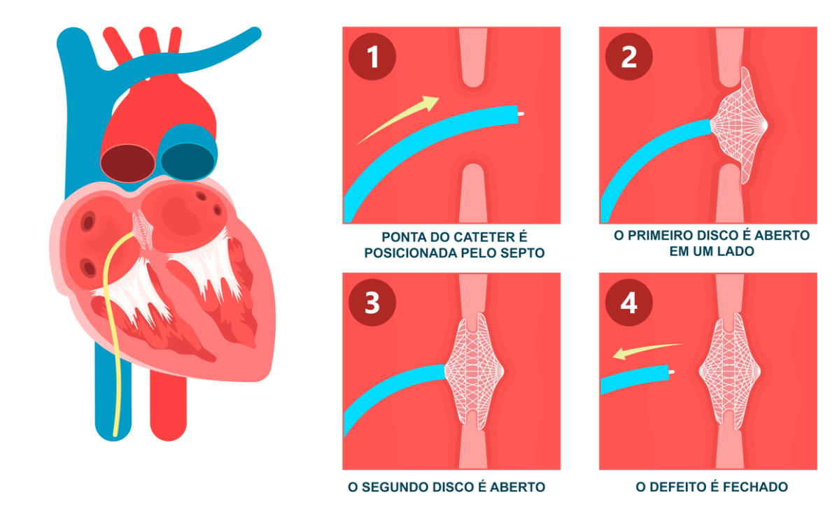 Diagrama do procedimento de cateterismo cardíaco: um cateter é inserido em uma veia, através de um coágulo, para restaurar o fluxo sanguíneo.