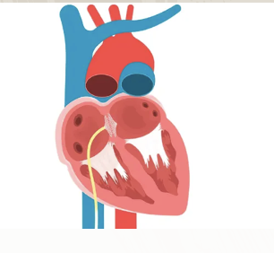 Diagrama de um coração mostrando as câmaras internas, com um tubo amarelo fino inserido, próximo à aorta e à veia pulmonar.