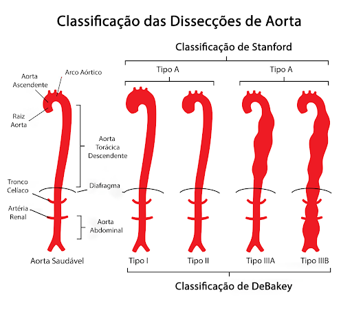 Diagrama ilustrando as classificações de dissecção aórtica. A aorta é mostrada, com as classificações de Stanford e DeBakey para diferentes tipos de dissecção.