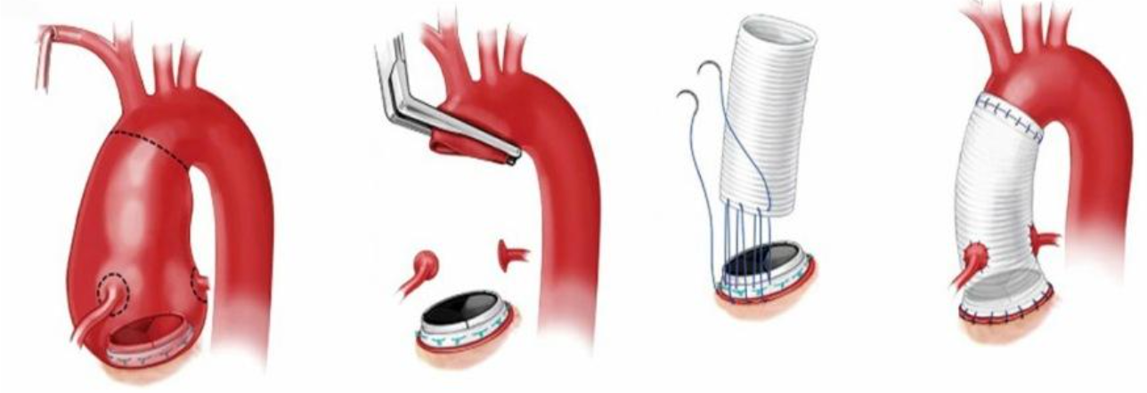 Diagrama da cirurgia de reparo do arco aórtico, mostrando as etapas desde a aorta danificada até a colocação de um enxerto.