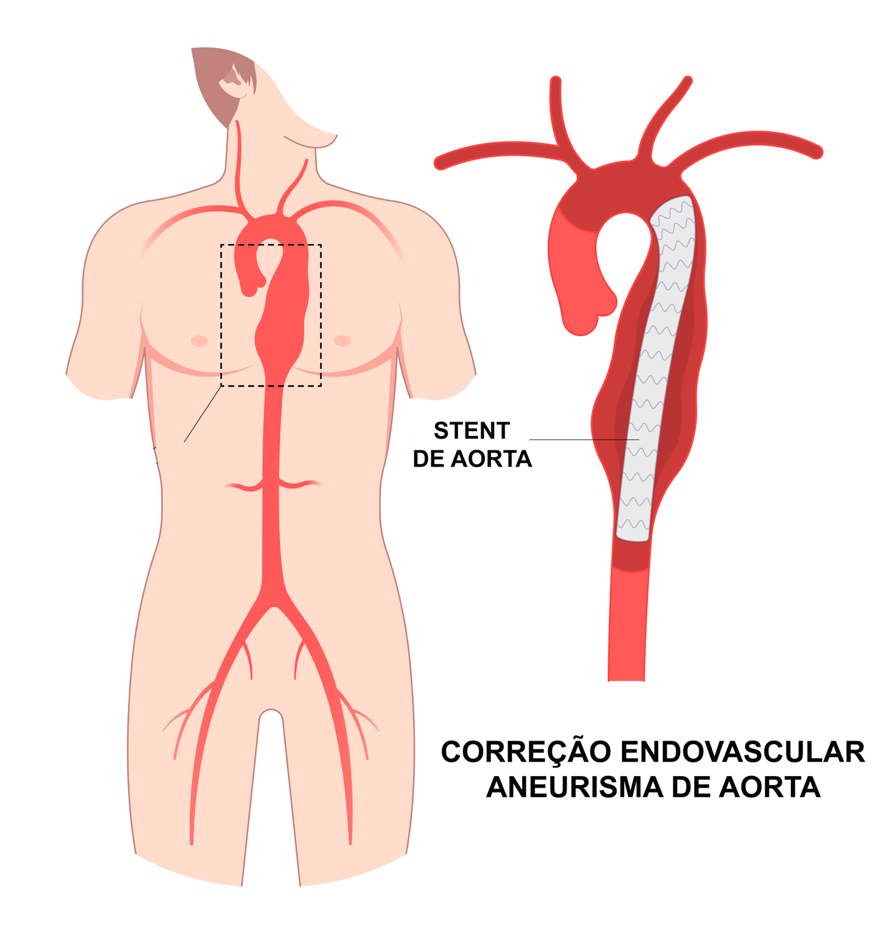Diagrama da aorta com um stent endovascular. Aorta em vermelho com um stent posicionado para corrigir um aneurisma.