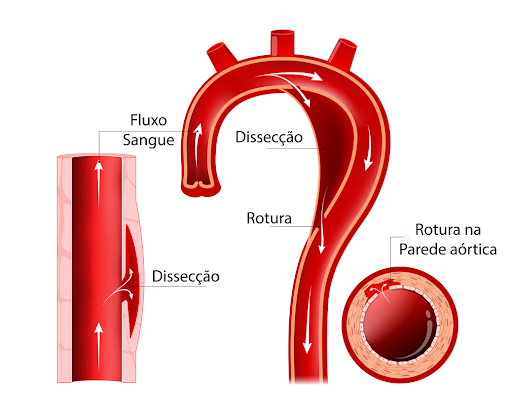 Diagrama de dissecção aórtica, mostrando o fluxo sanguíneo através de uma aorta com ruptura. As setas indicam a direção do fluxo sanguíneo.