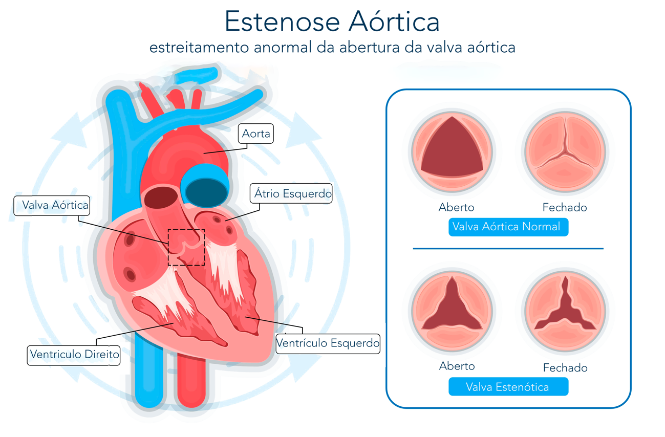 Diagrama de estenose aórtica, uma doença cardíaca. Uma válvula aórtica saudável comparada a uma estenótica. A imagem mostra a anatomia do coração e o fluxo sanguíneo.