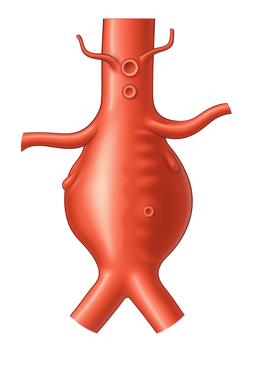 Ilustração de uma aorta abdominal vermelha e protuberante com artérias ramificadas.