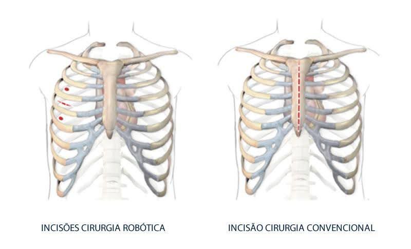 Diagrama comparando incisões cirúrgicas: cirurgia robótica (esquerda, pequenas incisões vermelhas) vs. cirurgia convencional (direita, longa incisão central) no tórax.