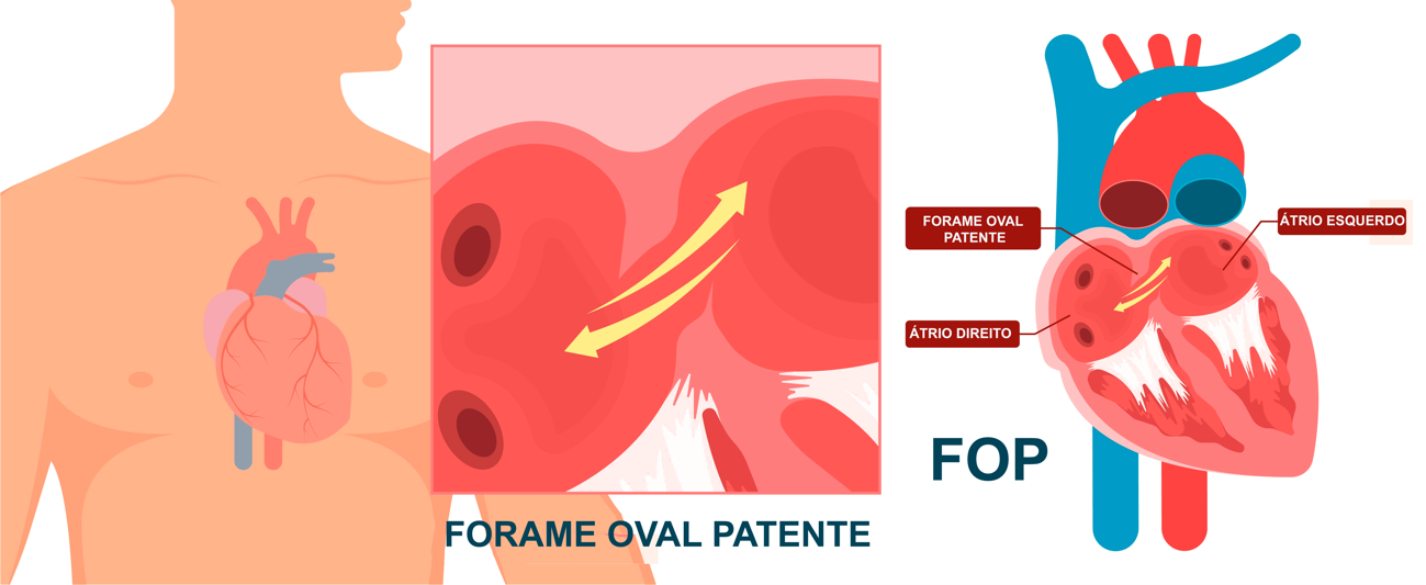 Ilustração de um coração humano com forame oval patente (FOP), mostrando o fluxo sanguíneo e suas características anatômicas.