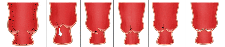 Diagrama representando a abertura e o fechamento de uma válvula cardíaca, mostrado em vermelho, em vários estágios.