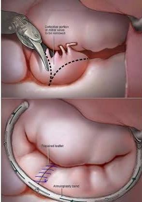 Ilustração médica de dois painéis: cirurgia da válvula mitral. A parte superior mostra a dissecção da válvula, a parte inferior mostra a válvula reparada com suturas e uma banda de anuloplastia.