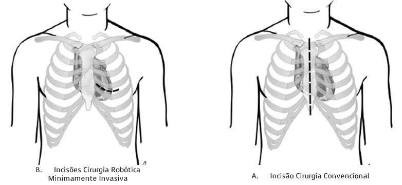 Diagrama comparando a cirurgia cardíaca minimamente invasiva (esquerda) com a cirurgia convencional (direita), mostrando os locais das incisões no tórax.