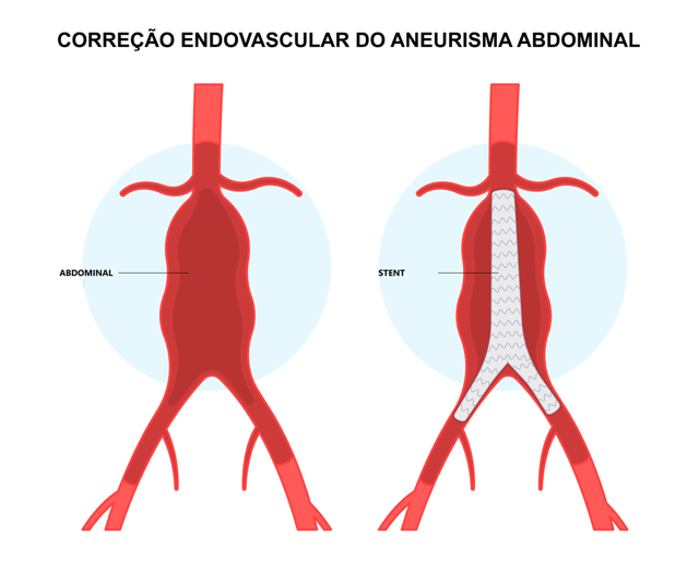 Diagrama mostrando o reparo endovascular de um aneurisma da aorta abdominal. O aneurisma é vermelho e uma endoprótese cinza substitui a seção enfraquecida.