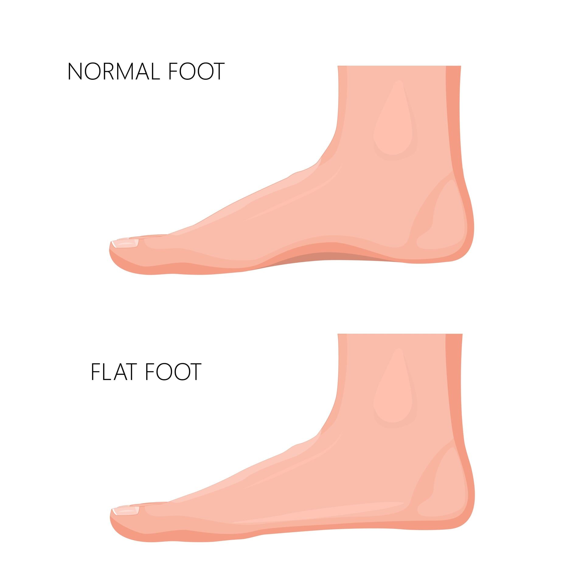 Pied. Flat footed. Flat footed. Knuckles anatomy. Flat footed.