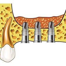 figura di viti inserite nel cavo orale attraverso interventi di chirurgia orale e maxillo-facciale