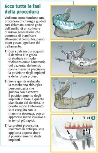 figura con immagini e testo relativi alle fasi della procedura di chirurgia guidata