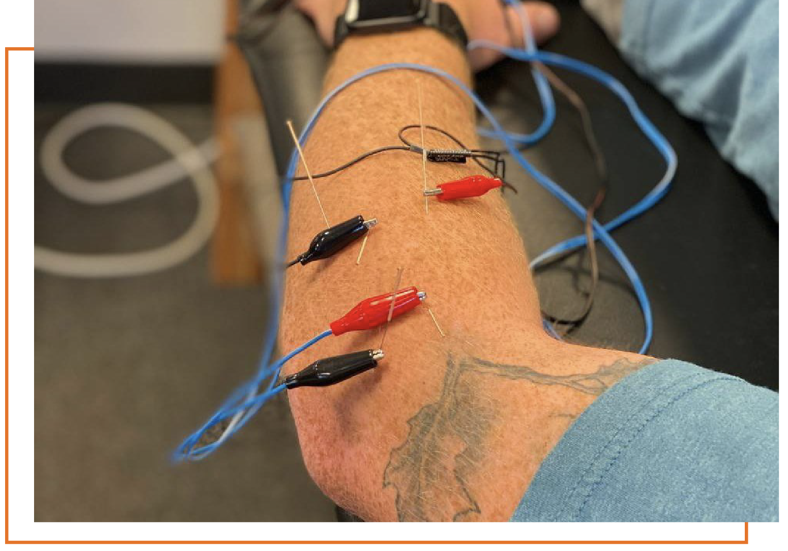 Dry needling services for elbow pain relief