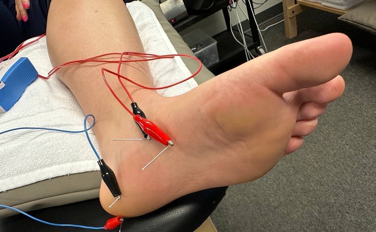 dry needling for plantar fasciitis