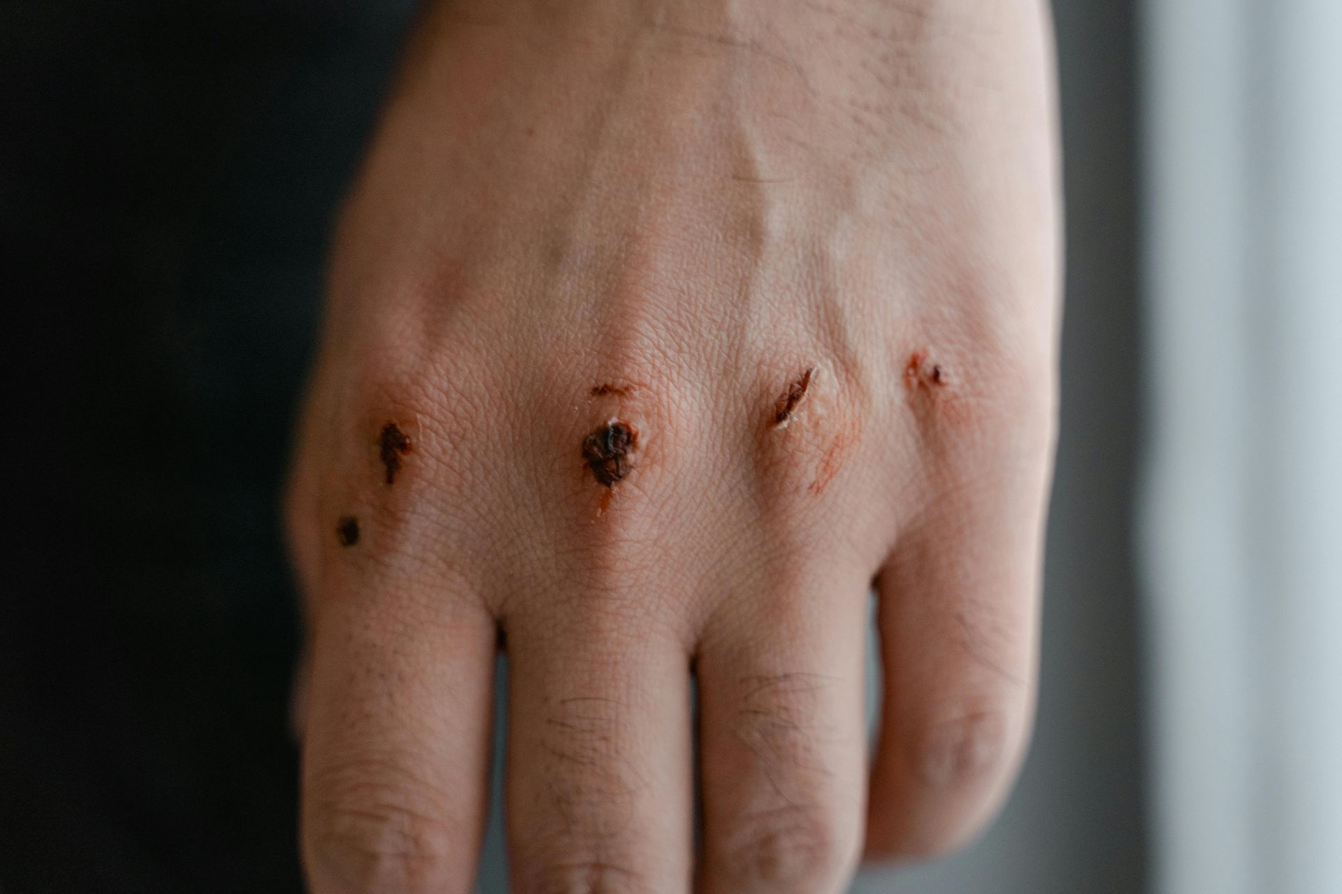 A close up of a person 's hand with a lot of stitches on it.
