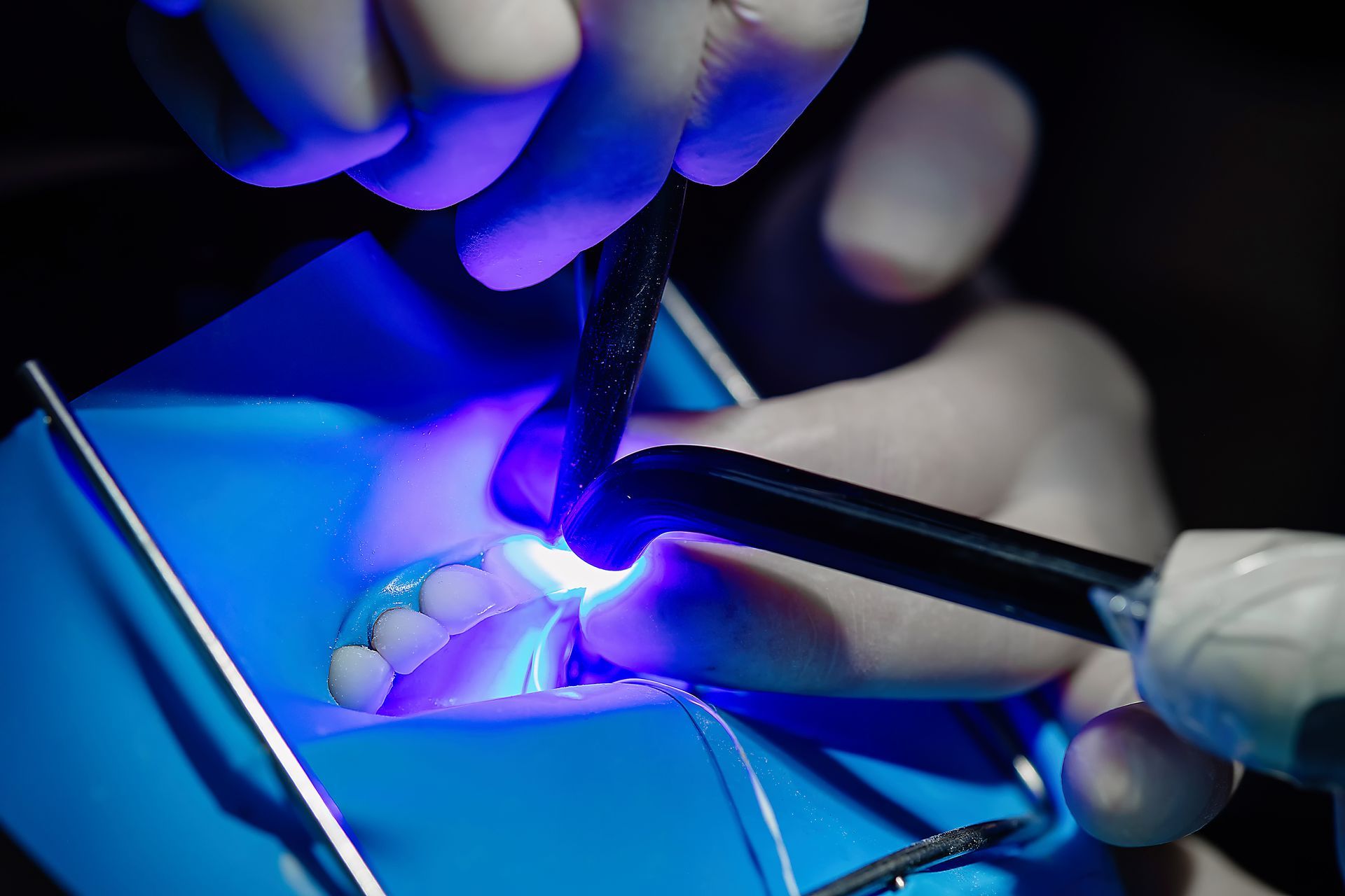 Close-up of a cosmetic dentist's hands treating bonding veneers with UV curing light