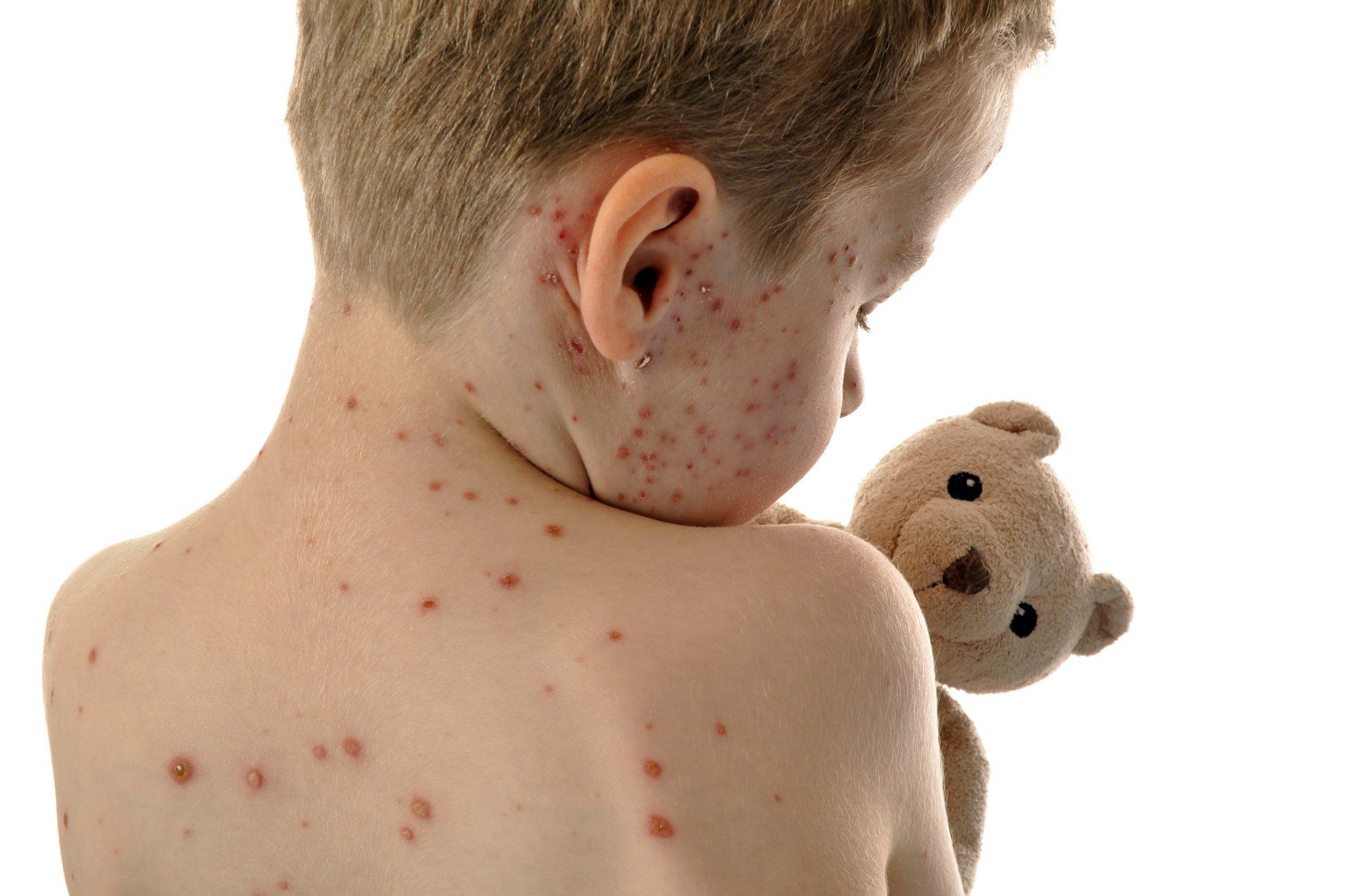 a young boy with chickenpox is holding a teddy bear .