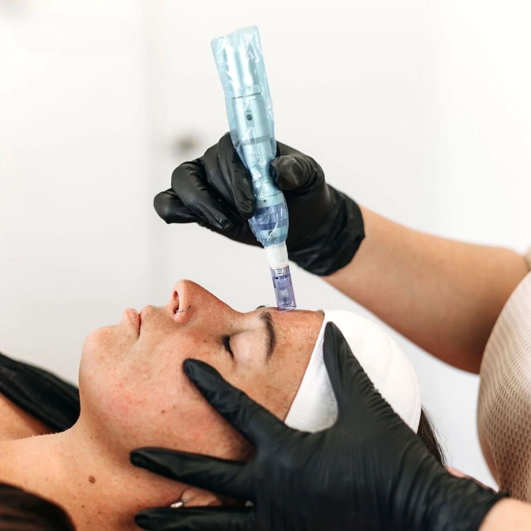 Woman is Getting a Treatment on Her Face — Gladstone Beauty Clinic In Gladstone Central, QLD